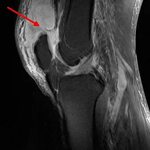 Quadrizeps- und Patellasehnen OP - ARCUS Kliniken